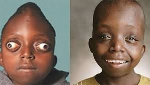 Hội chứng Crouzon - Hình ảnh minh họa